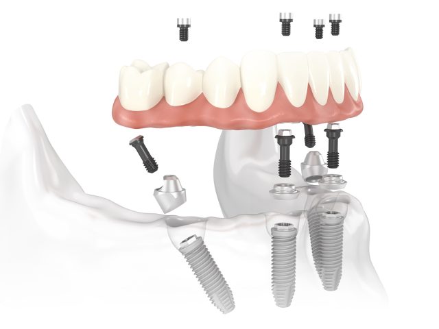 Boronia-Heights-Family-Dental-Implants