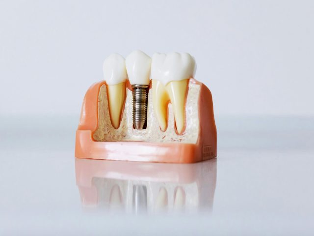 Boronia-Heights-Family-Dental-Implants