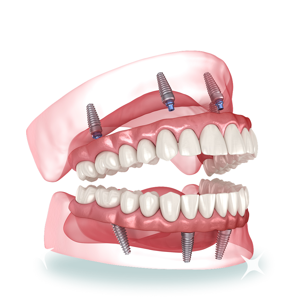 discover-all-on-4 https://www.boroniaheightsfamilydental.com.au/wp-content/uploads/2025/06/discover-all-on-4.png